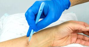 طرق الوقاية من الخراج