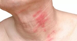 طرق علاج الهربس