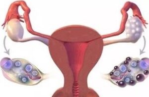 علاج تكيس المبايض