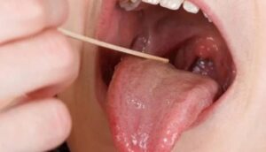 كيفية علاج التهاب الحلق